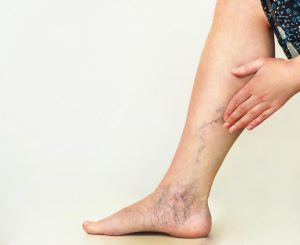 Venous Insufficiency